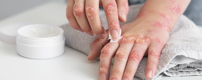 Psoriáza u detí: Je to to isté čo lupienka a dá sa vyliečiť?